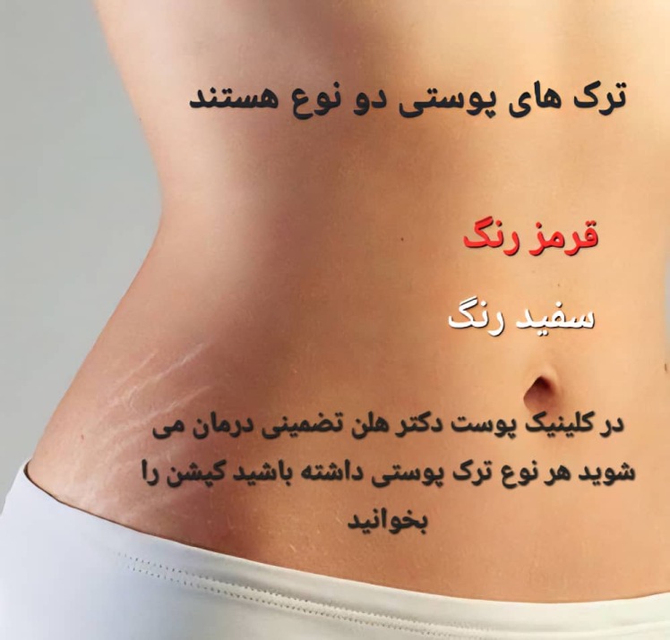 روش های درمان ترک های پوستی 
