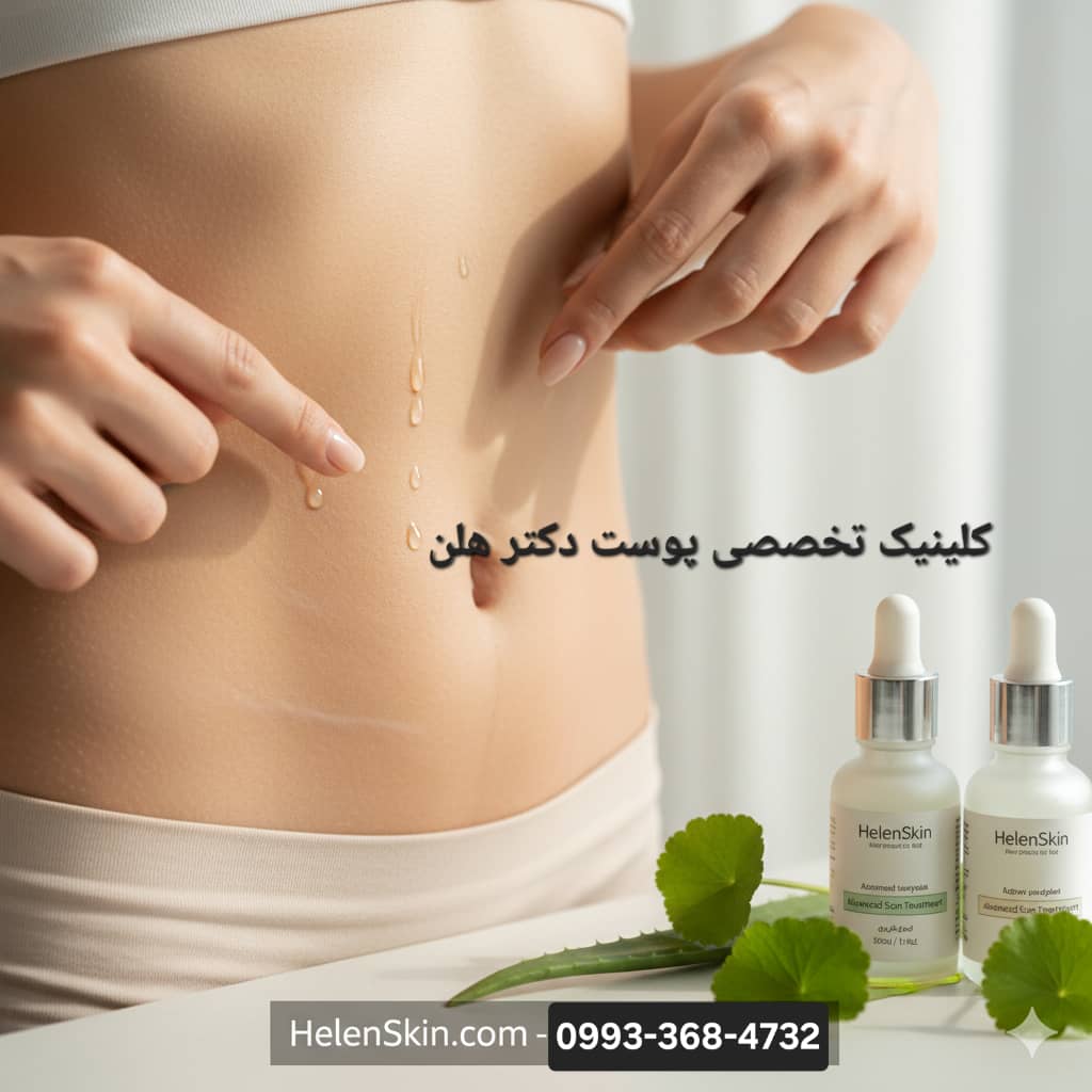 درمان پوست های ترک ترک شده یا دارای استریا در کلینیک دکتر هلن