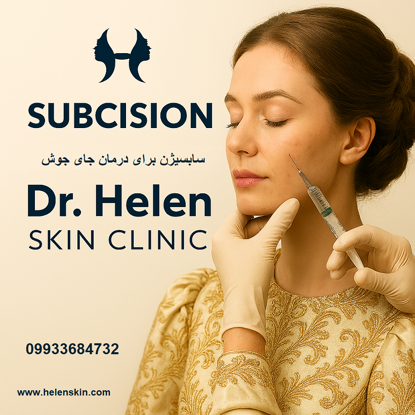 پاسخ به ۱۵ سوال پرتکرار شما در مورد سابسیژن کلینیک پوست دکتر هلن <img src="subcision-treatment.jpg" alt="تصویر درمان سابسیژن برای جای جوش">