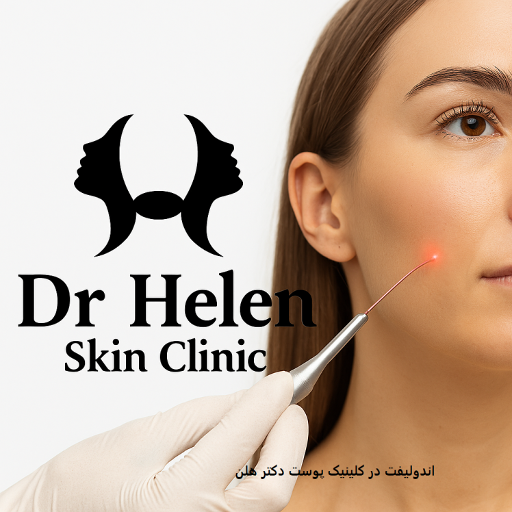 اندولیفت Endo lift